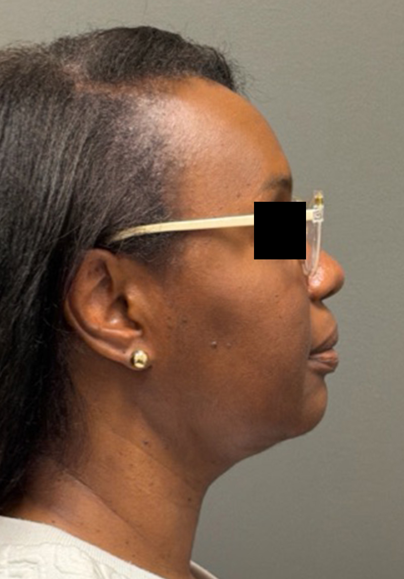NECK LIFT Before & After Gallery - Patient 419306 - Image 2