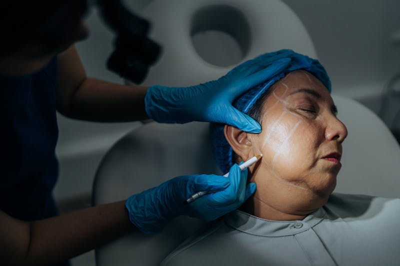 Woman being marked up for a facelift