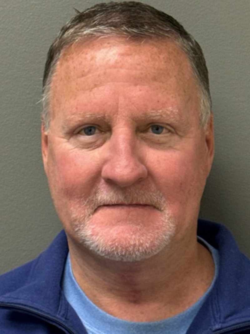 FAT GRAFTING Before & After Gallery - Patient 304195 - Image 2