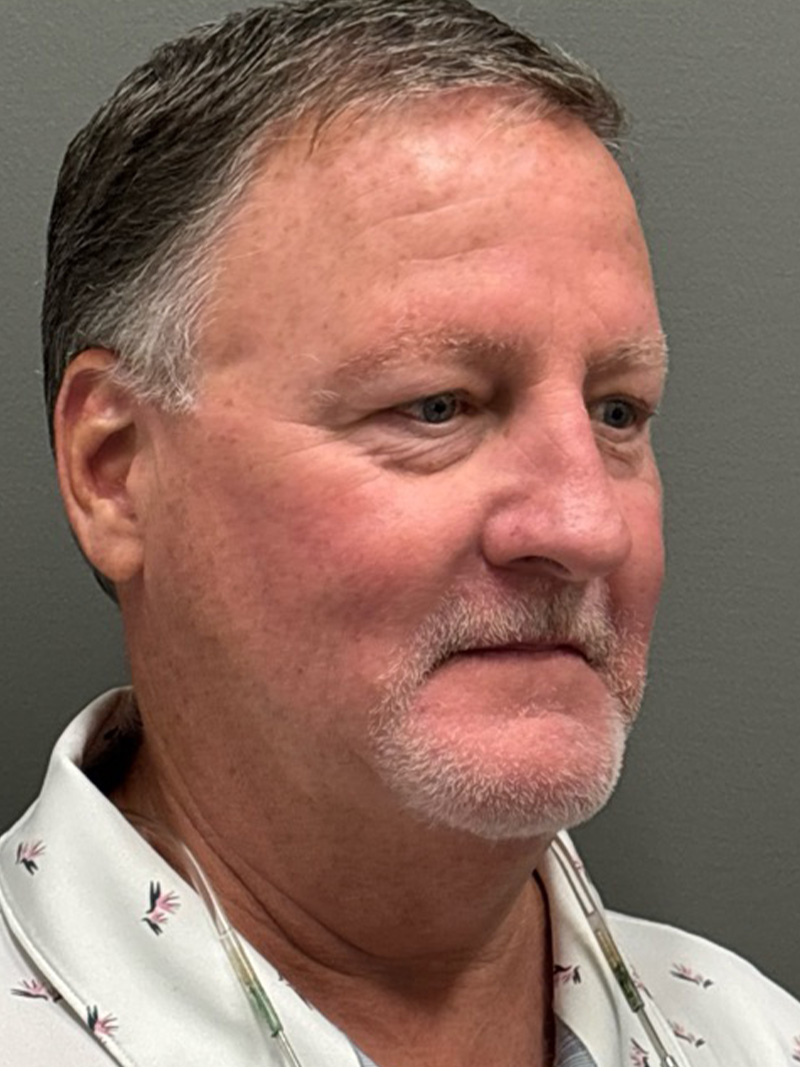 FAT GRAFTING Before & After Gallery - Patient 304195 - Image 3