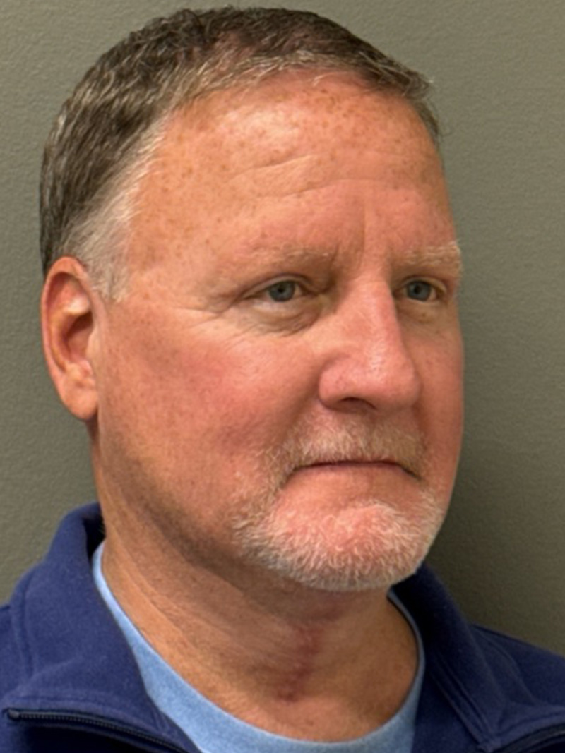 FAT GRAFTING Before & After Gallery - Patient 304195 - Image 4