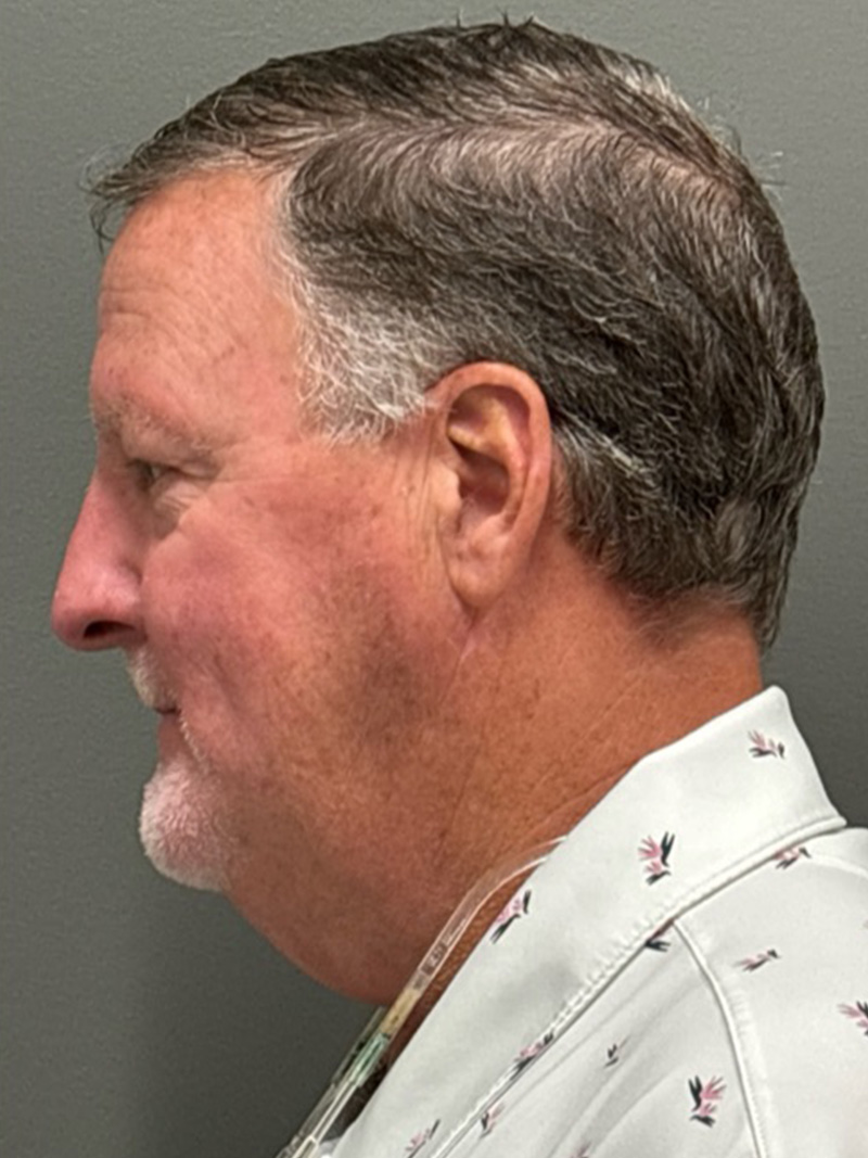 FAT GRAFTING Before & After Gallery - Patient 304195 - Image 5