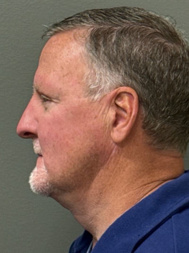 FAT GRAFTING Before & After Gallery - Patient 304195 - Image 6