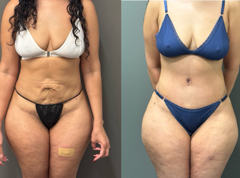 ABDOMINOPLASTY REVISIONS Before & After Gallery - Patient 276537 - Image 1