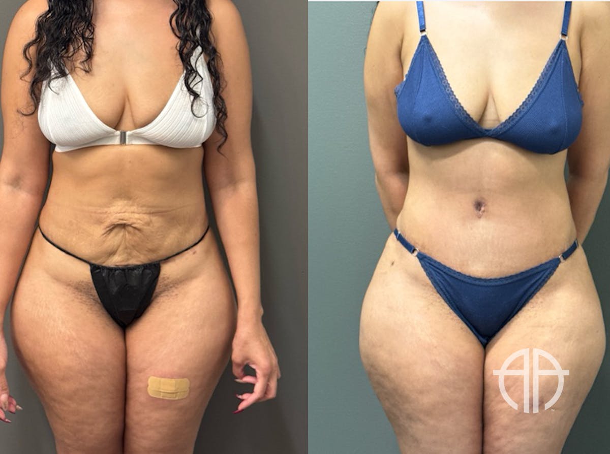 ABDOMINOPLASTY REVISIONS Before & After Gallery - Patient 276537 - Image 1