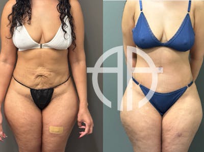 ABDOMINOPLASTY REVISIONS Before & After Gallery - Patient 276537 - Image 1