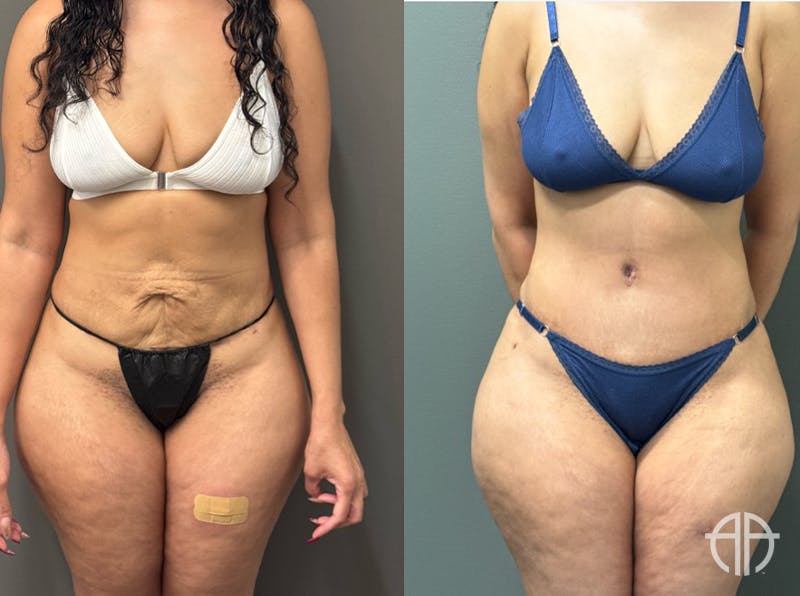 ABDOMINOPLASTY REVISIONS Before & After Gallery - Patient 276537 - Image 1