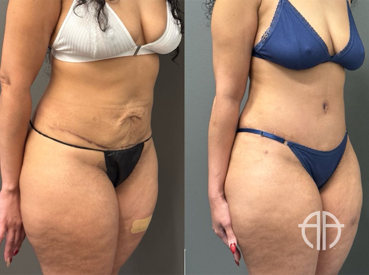 ABDOMINOPLASTY REVISIONS Before & After Gallery - Patient 276537 - Image 2