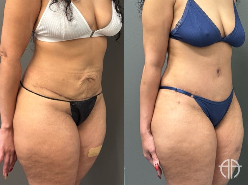 ABDOMINOPLASTY REVISIONS Before & After Gallery - Patient 276537 - Image 2