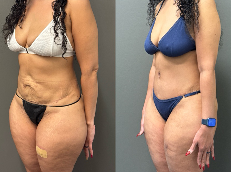 ABDOMINOPLASTY REVISIONS Before & After Gallery - Patient 276537 - Image 3