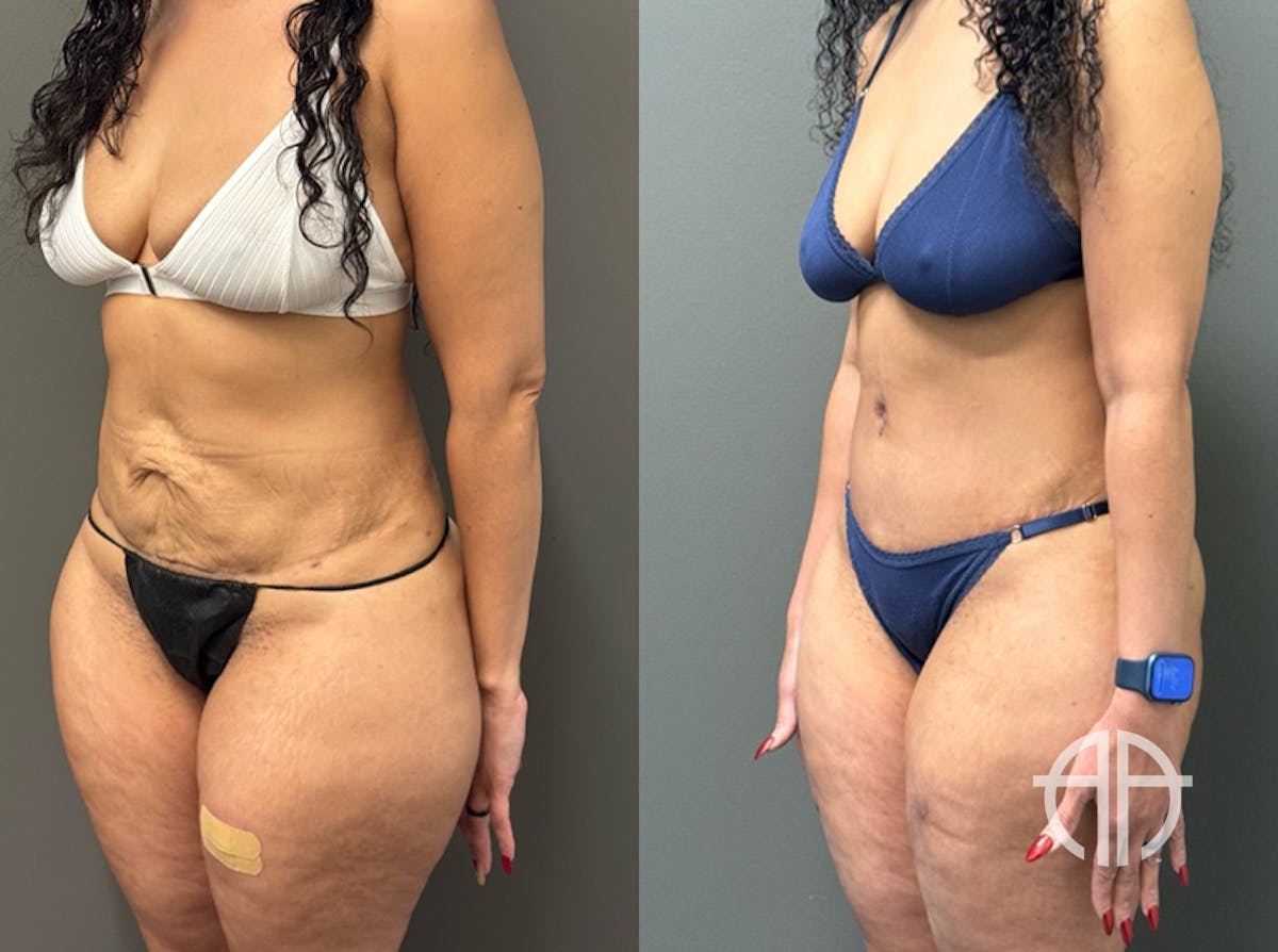 ABDOMINOPLASTY REVISIONS Before & After Gallery - Patient 276537 - Image 3