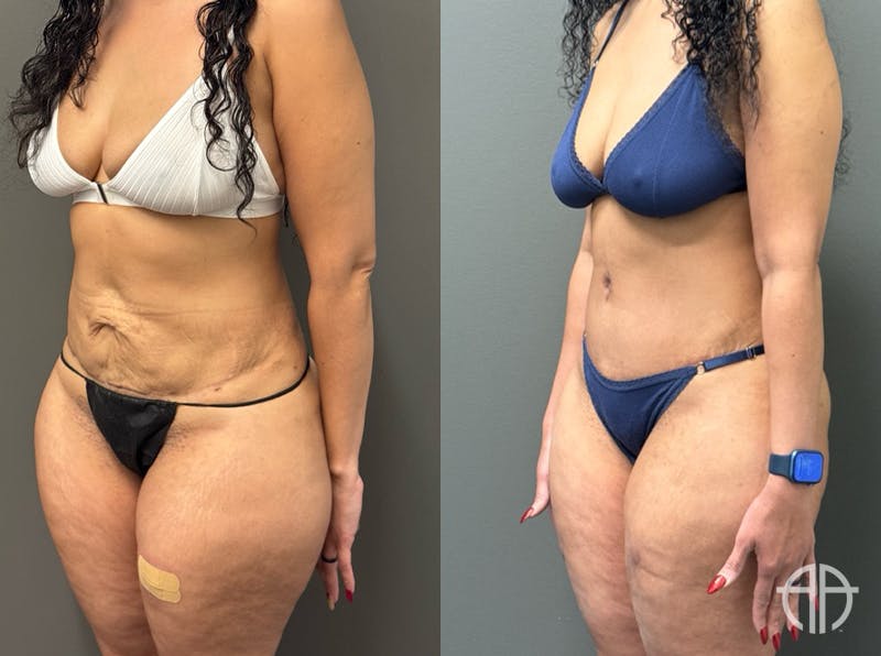 ABDOMINOPLASTY REVISIONS Before & After Gallery - Patient 276537 - Image 3