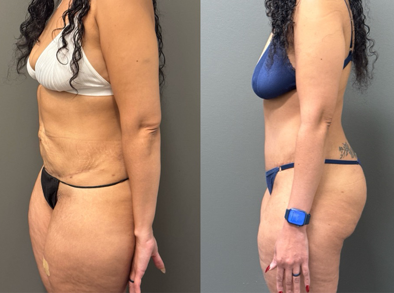 ABDOMINOPLASTY REVISIONS Before & After Gallery - Patient 276537 - Image 4