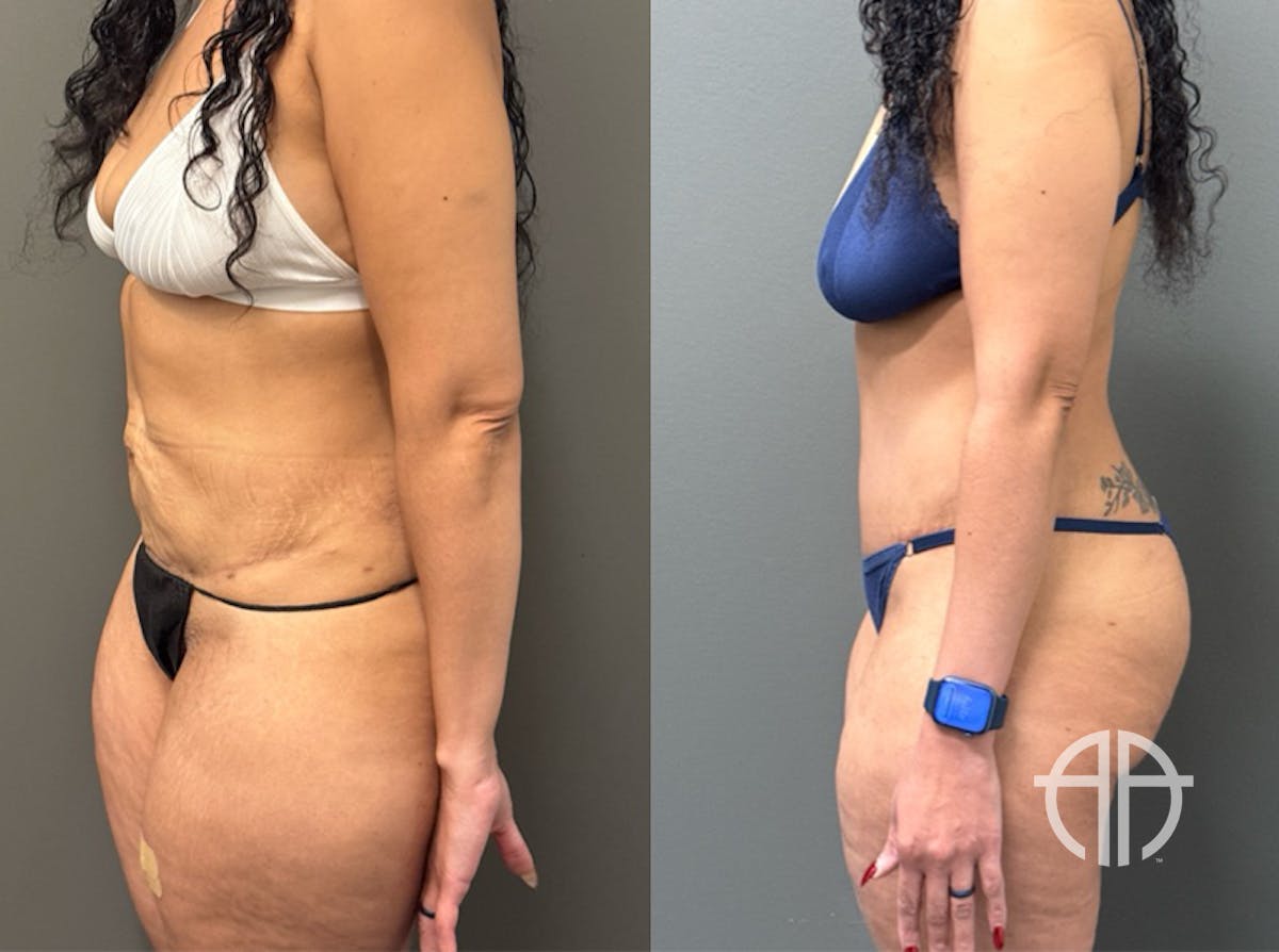 ABDOMINOPLASTY REVISIONS Before & After Gallery - Patient 276537 - Image 4