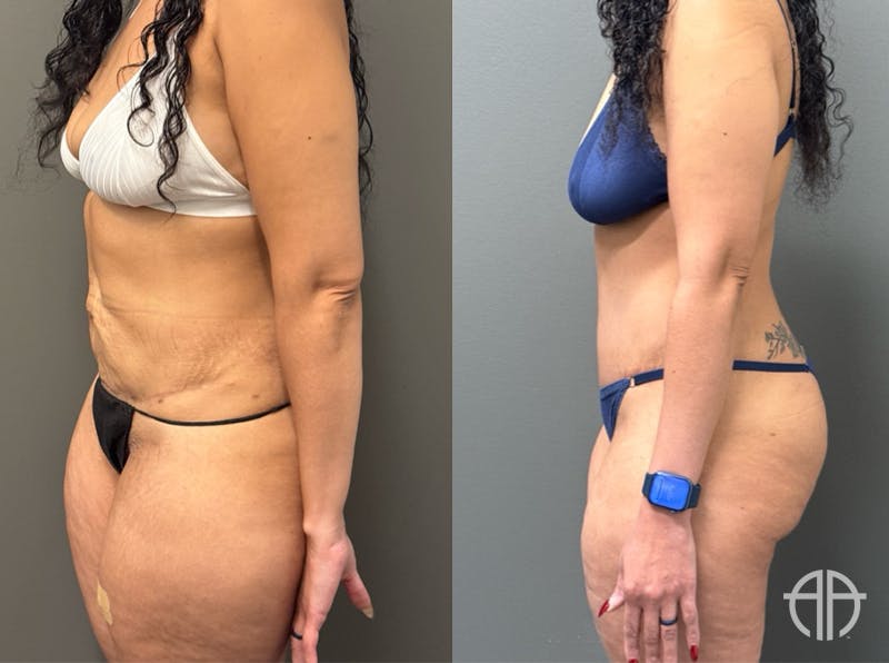 ABDOMINOPLASTY REVISIONS Before & After Gallery - Patient 276537 - Image 4