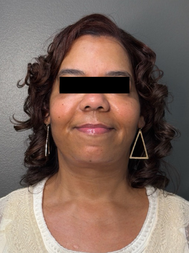 FAT GRAFTING Before & After Gallery - Patient 194960 - Image 2