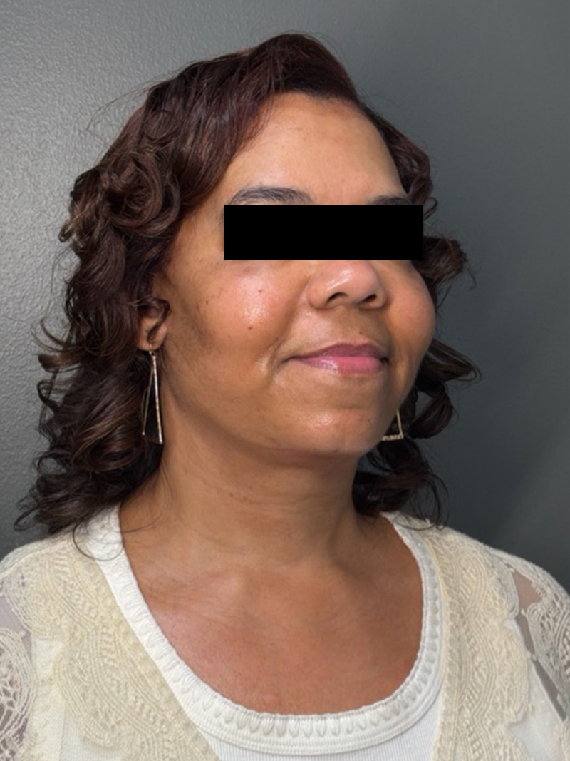 FAT GRAFTING Before & After Gallery - Patient 194960 - Image 4