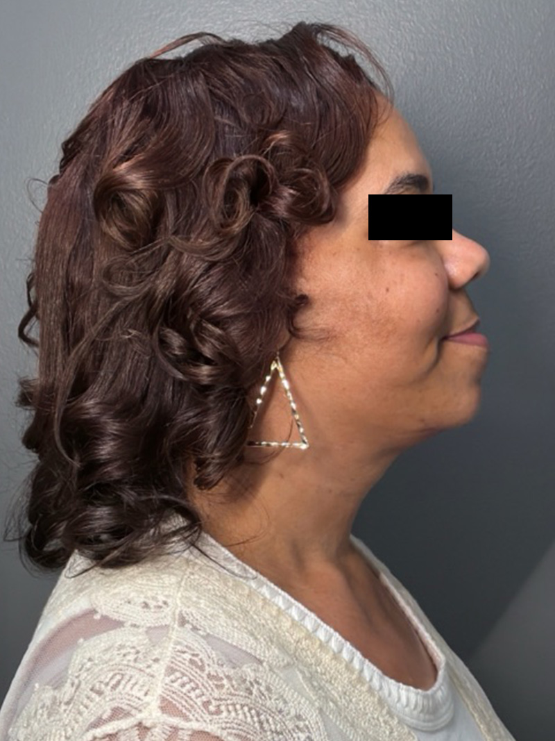 FAT GRAFTING Before & After Gallery - Patient 194960 - Image 6