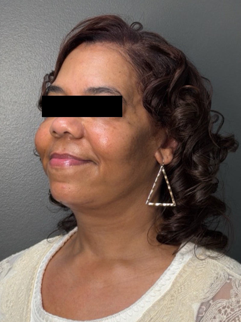 FAT GRAFTING Before & After Gallery - Patient 194960 - Image 8
