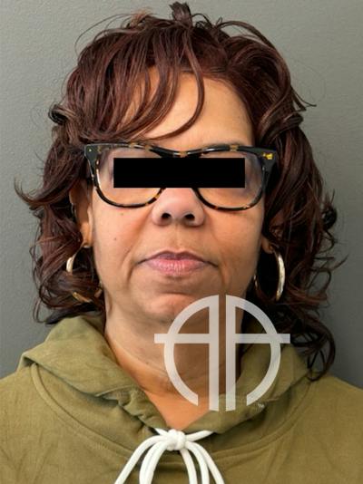 FACELIFT Before & After Gallery - Patient 335110 - Image 1