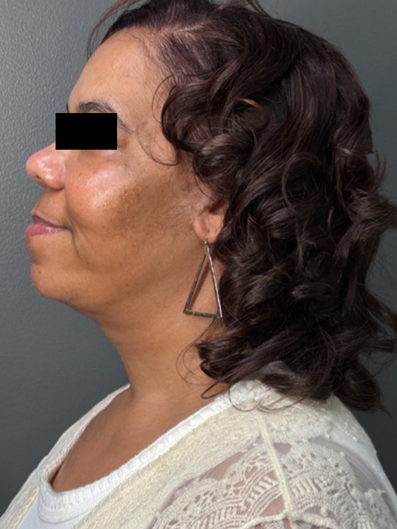 FAT GRAFTING Before & After Gallery - Patient 194960 - Image 10