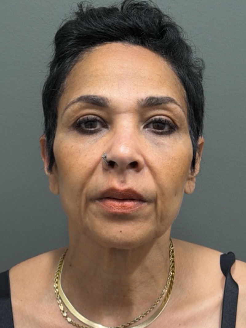 FACELIFT Before & After Gallery - Patient 399211 - Image 1