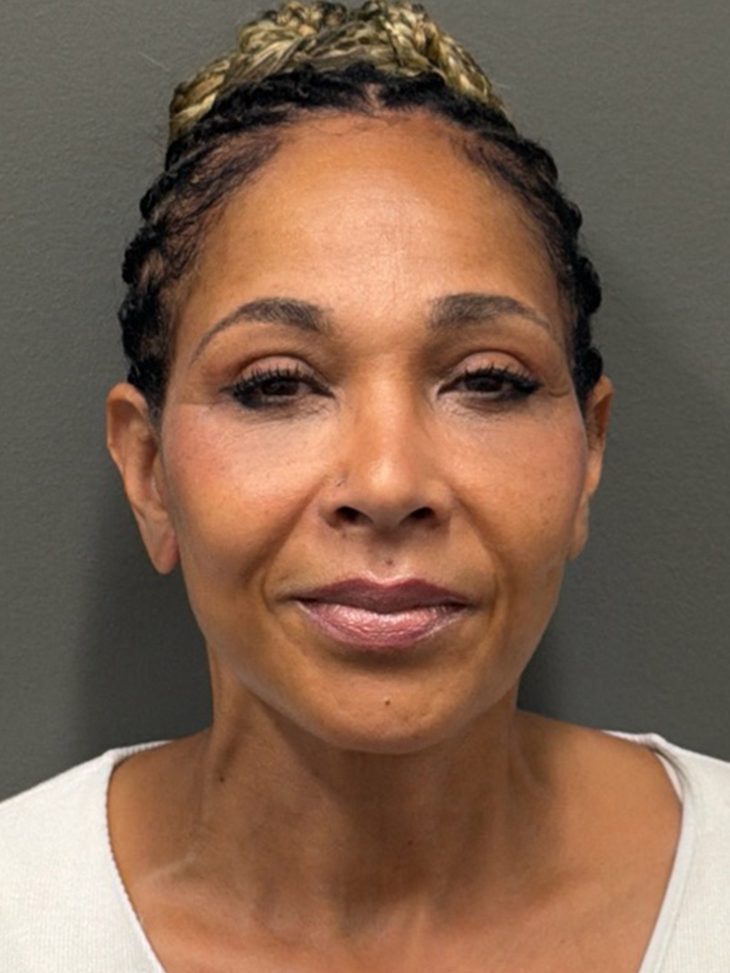 FACELIFT Before & After Gallery - Patient 399211 - Image 2