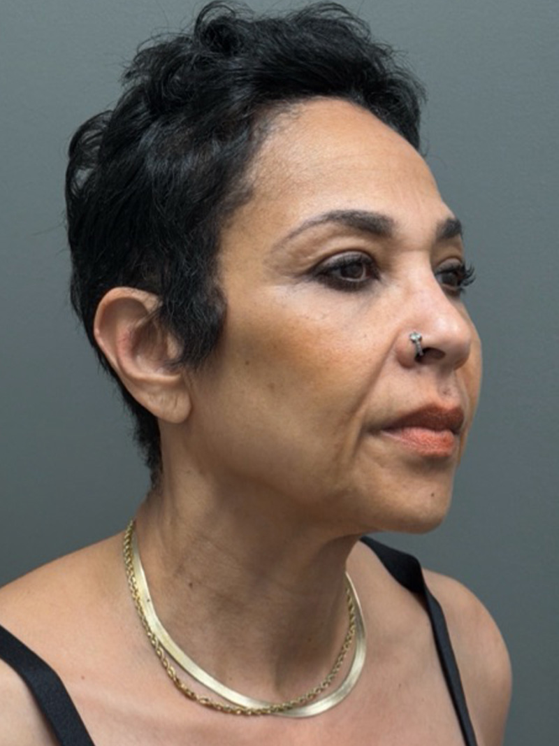 FACELIFT Before & After Gallery - Patient 399211 - Image 3