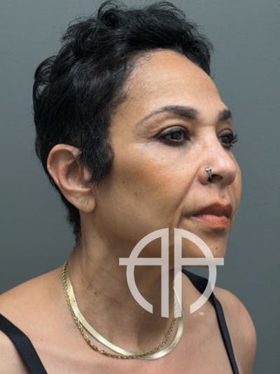 NECK LIFT Before & After Gallery - Patient 328106 - Image 1