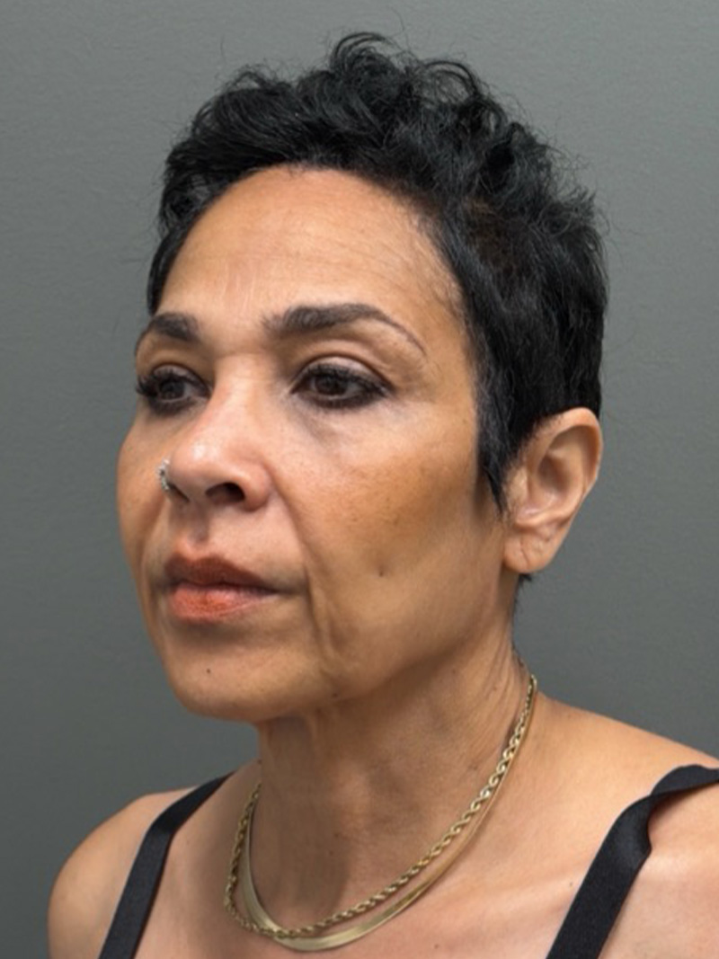 FACELIFT Before & After Gallery - Patient 399211 - Image 5
