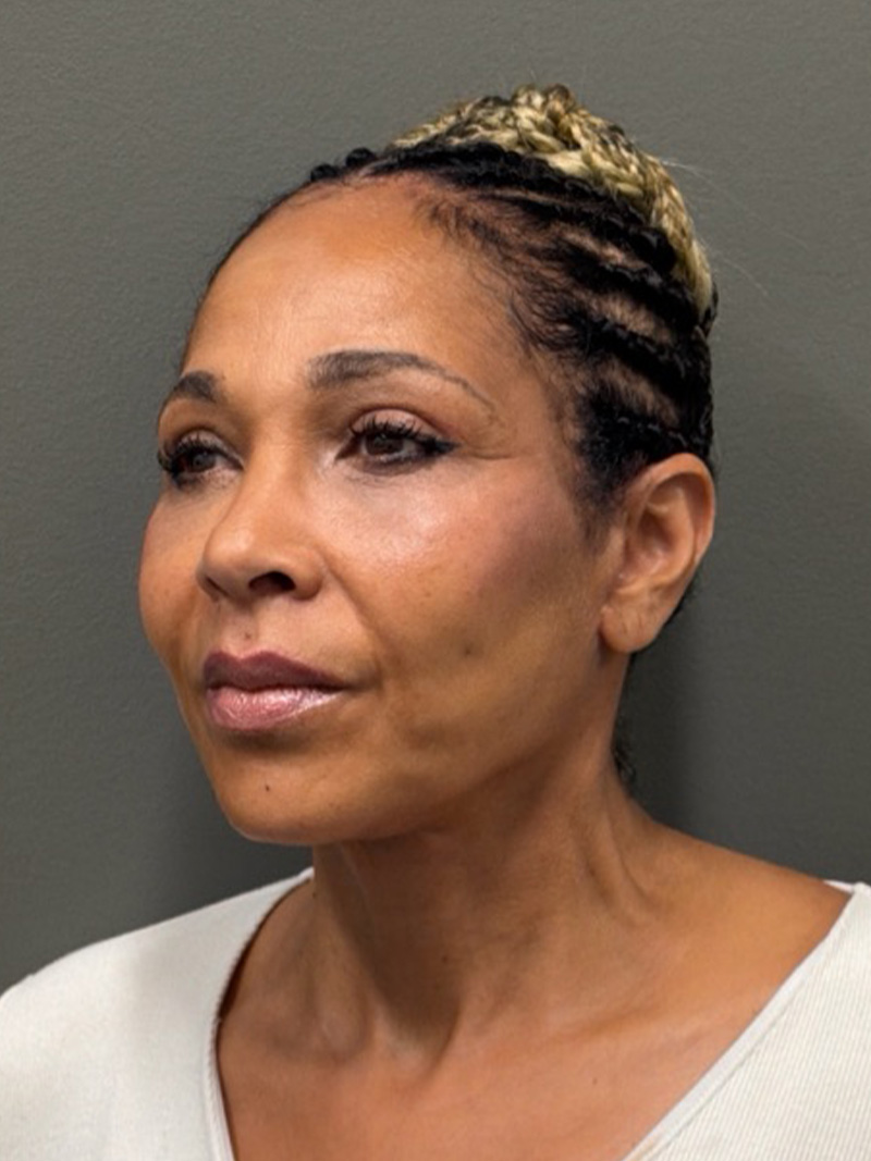 FACELIFT Before & After Gallery - Patient 399211 - Image 6