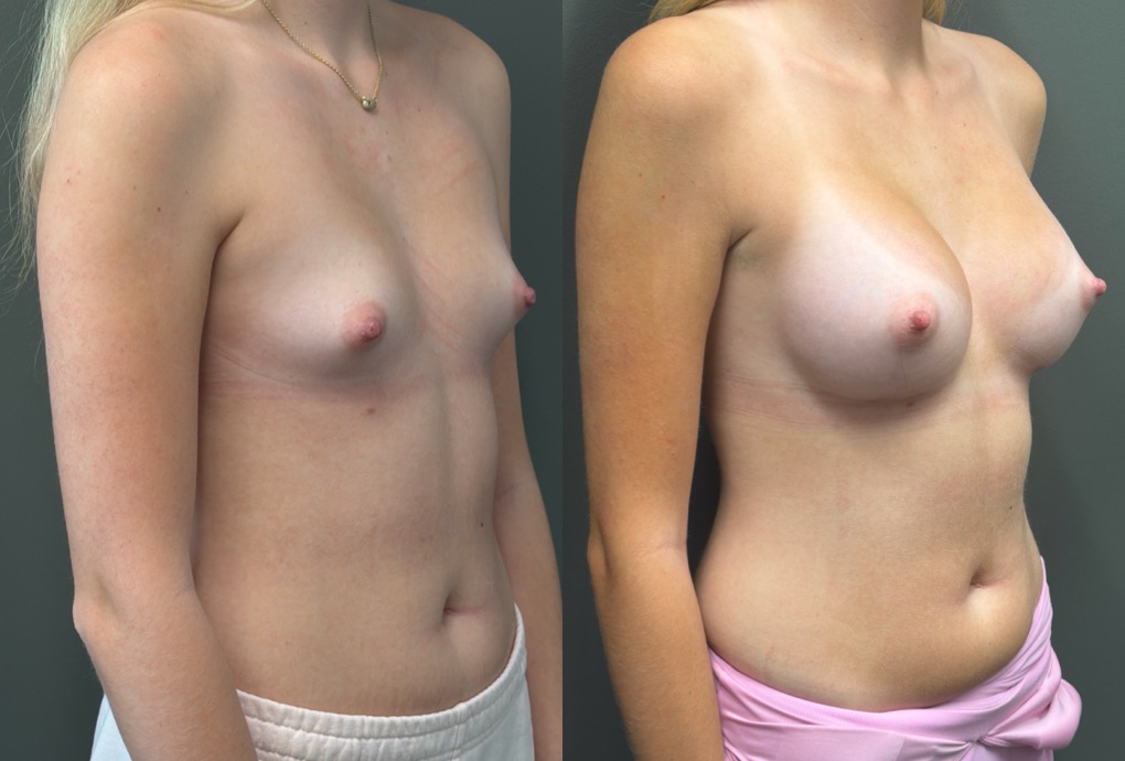 BREAST AUGMENTATION Before & After Gallery - Patient 183928 - Image 2