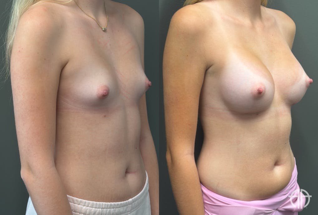 BREAST AUGMENTATION Before & After Gallery - Patient 183928 - Image 2