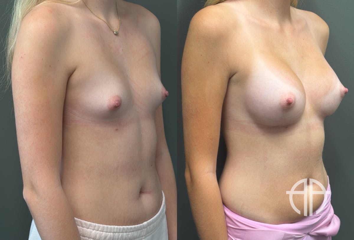 BREAST AUGMENTATION Before & After Gallery - Patient 183928 - Image 2