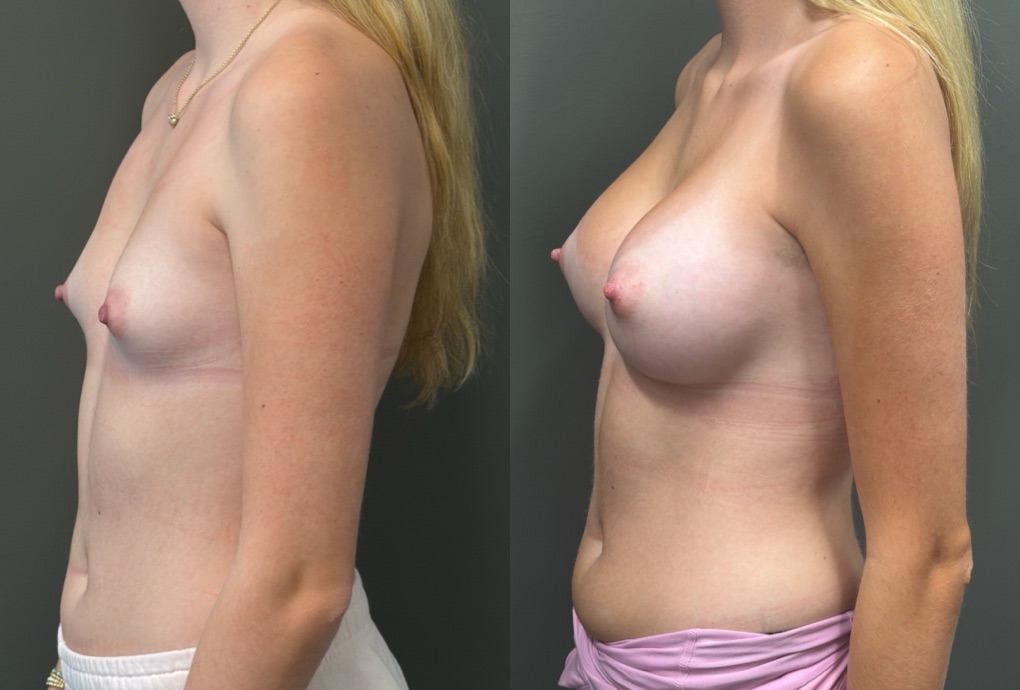 BREAST AUGMENTATION Before & After Gallery - Patient 183928 - Image 3