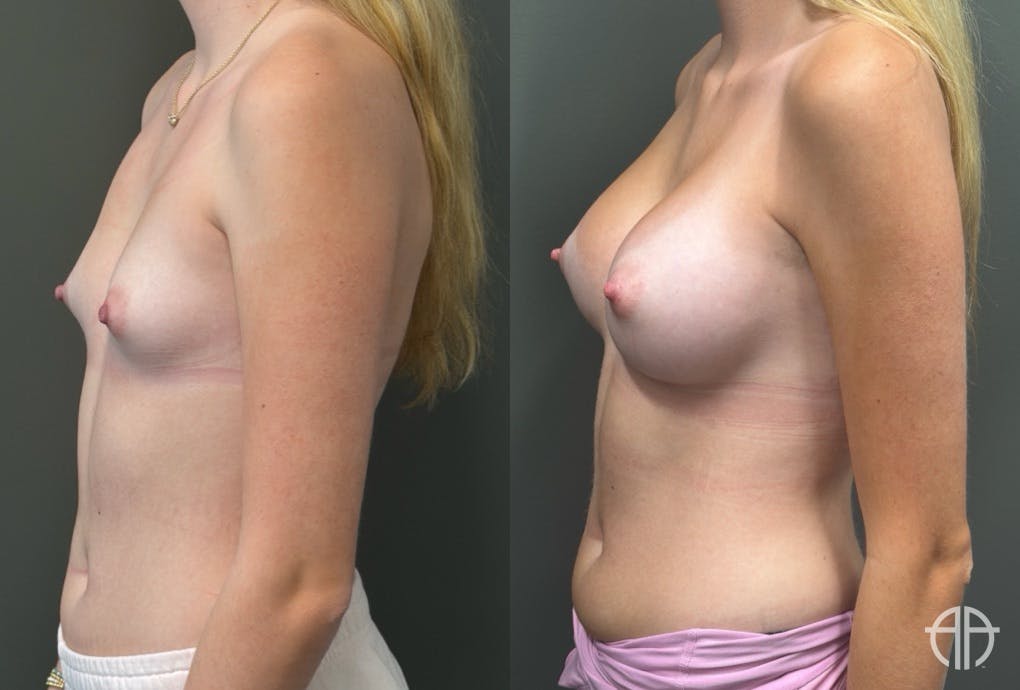BREAST AUGMENTATION Before & After Gallery - Patient 183928 - Image 3