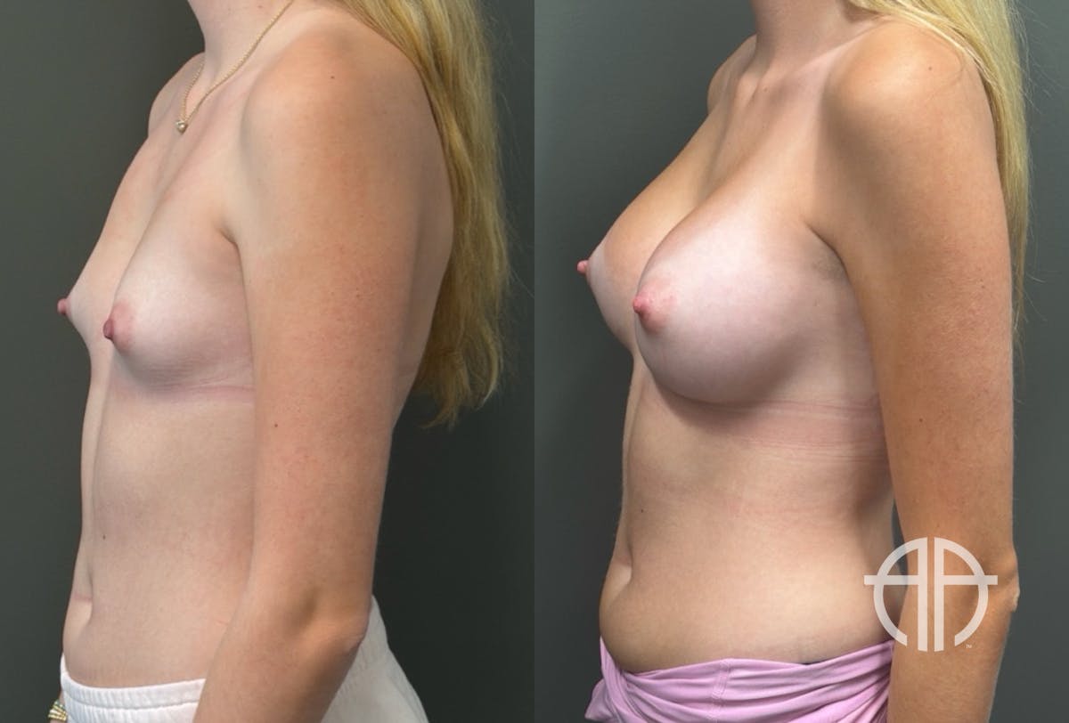 BREAST AUGMENTATION Before & After Gallery - Patient 183928 - Image 3