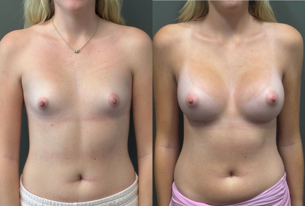 BREAST AUGMENTATION Before & After Gallery - Patient 183928 - Image 1