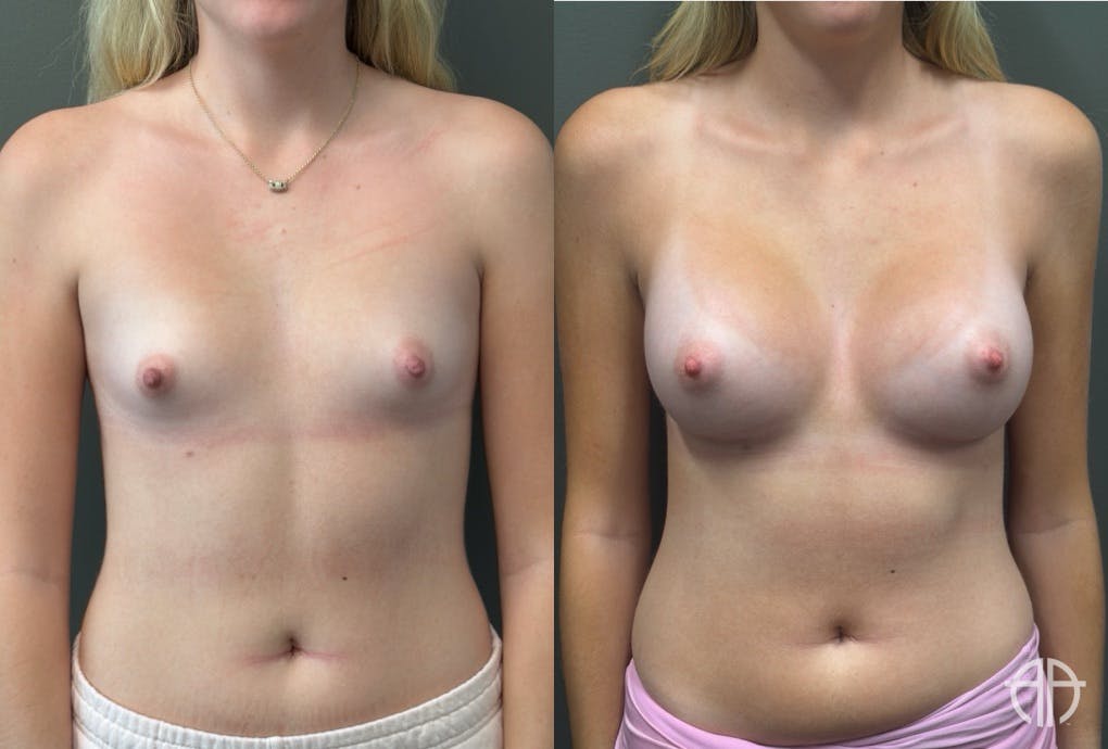 BREAST AUGMENTATION Before & After Gallery - Patient 183928 - Image 1