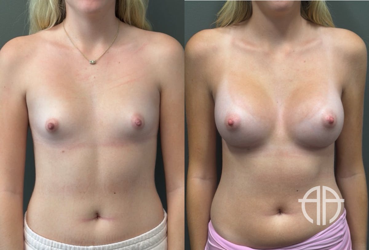 BREAST AUGMENTATION Before & After Gallery - Patient 183928 - Image 1