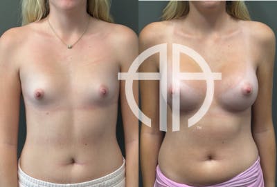 BREAST AUGMENTATION Before & After Gallery - Patient 183928 - Image 1