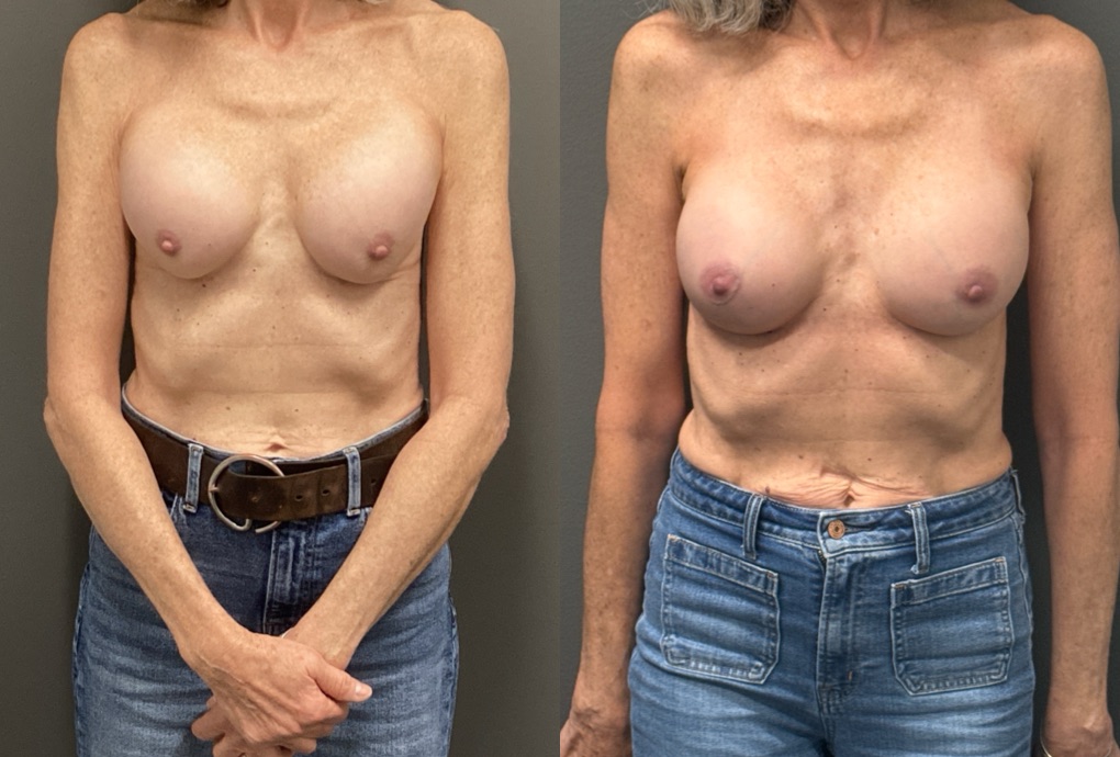 REVISIONS Before & After Gallery - Patient 419522 - Image 1