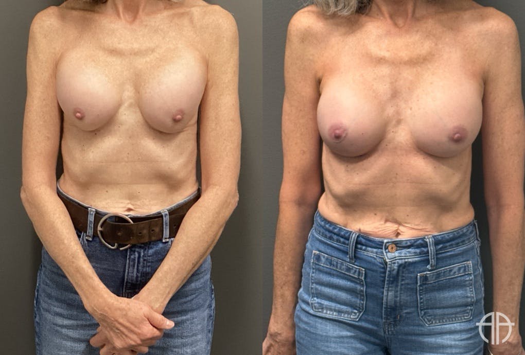 REVISIONS Before & After Gallery - Patient 419522 - Image 1