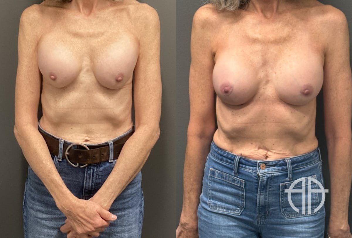REVISIONS Before & After Gallery - Patient 419522 - Image 1