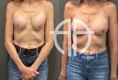 REVISIONS Before & After Gallery - Patient 419522 - Image 1