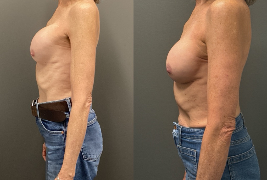 REVISIONS Before & After Gallery - Patient 419522 - Image 5