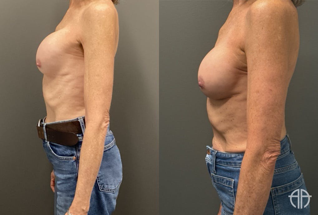 REVISIONS Before & After Gallery - Patient 419522 - Image 5