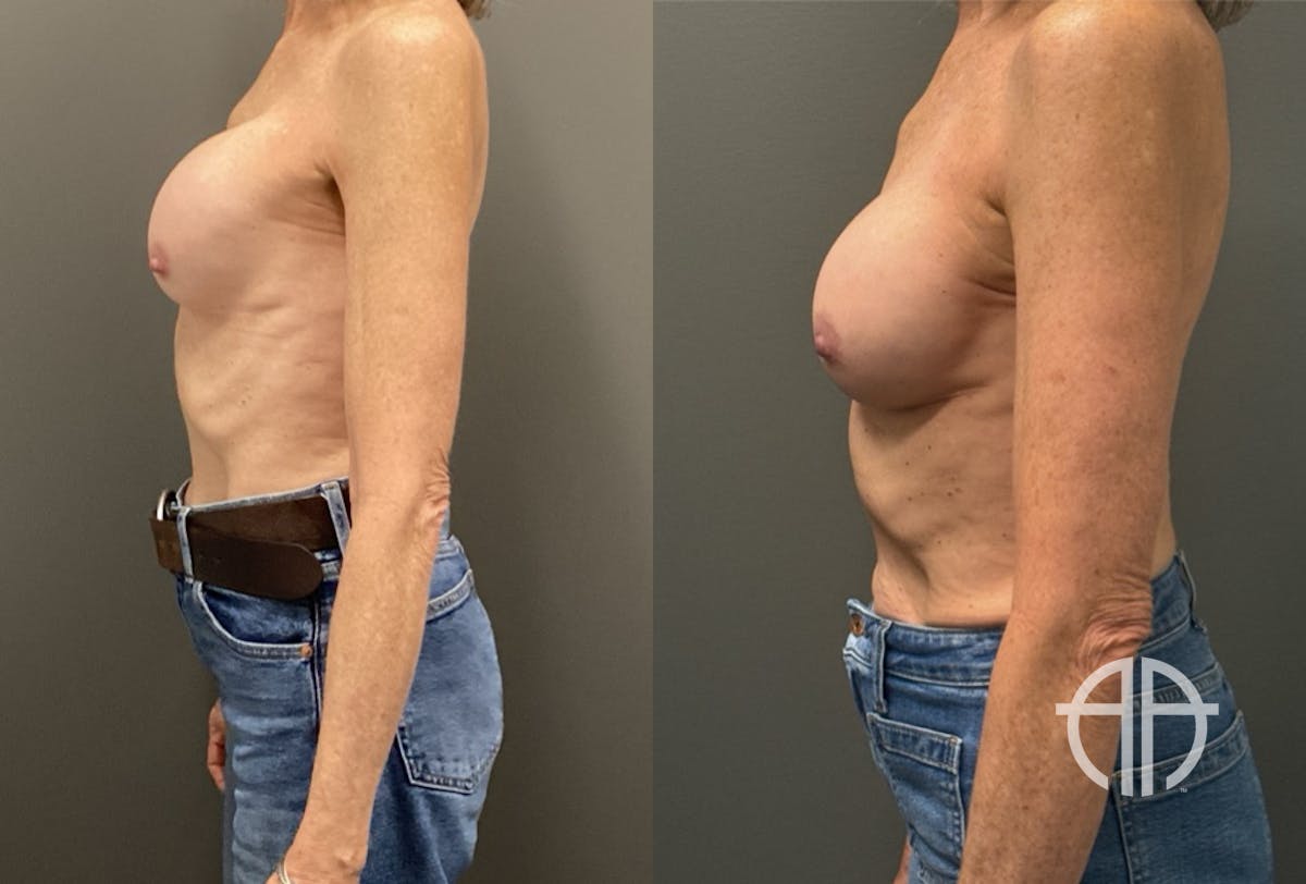 REVISIONS Before & After Gallery - Patient 419522 - Image 5
