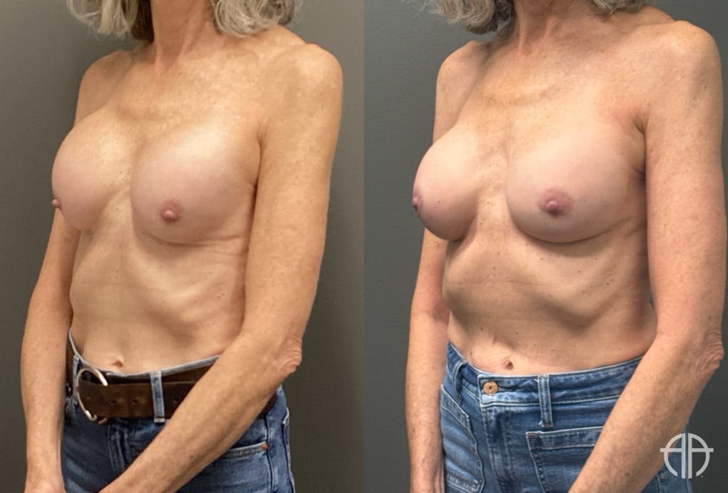 REVISIONS Before & After Gallery - Patient 419522 - Image 4