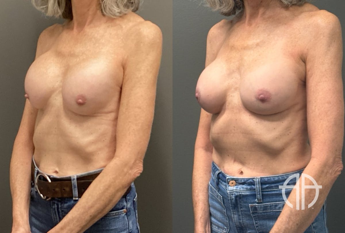 REVISIONS Before & After Gallery - Patient 419522 - Image 4